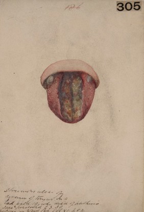 Tubercular ulceration of the dorsum of the tongue