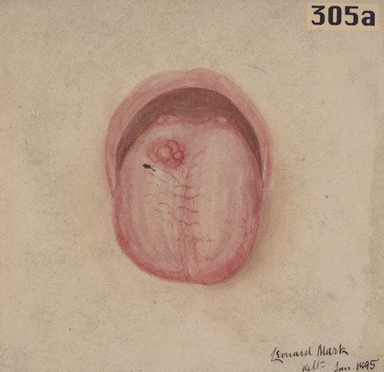 Tongue of a man with a tubercular ulcer