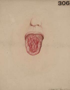 Tongue from a case of congenital syphilis