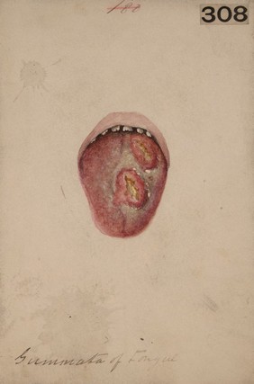 Syphilitic gummata in the tongue