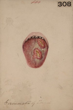 view Syphilitic gummata in the tongue