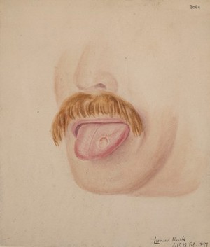 view Tongue with a primary syphilitic sore