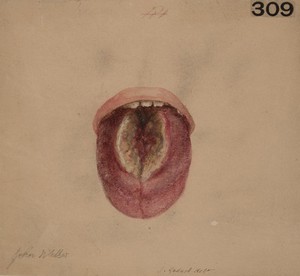 view Tertiary syphilitic disease of the tongue