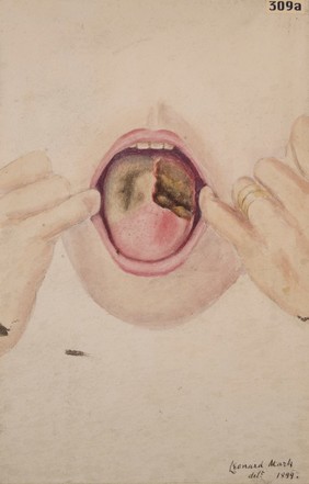 Tongue with tertiary syphilitic ulcer