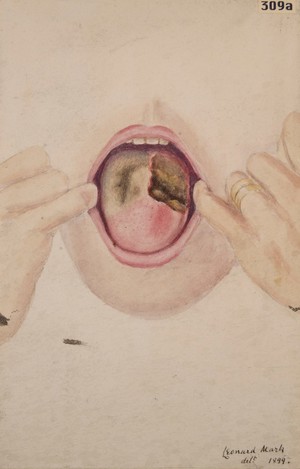 view Tongue with tertiary syphilitic ulcer