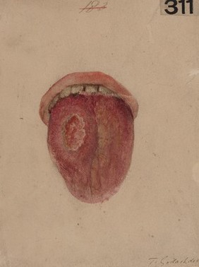 Tertiary syphilitic disease of the tongue