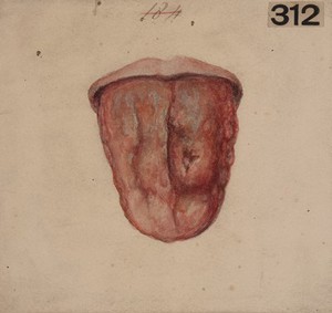 view Tertiary syphilitic disease of the tongue