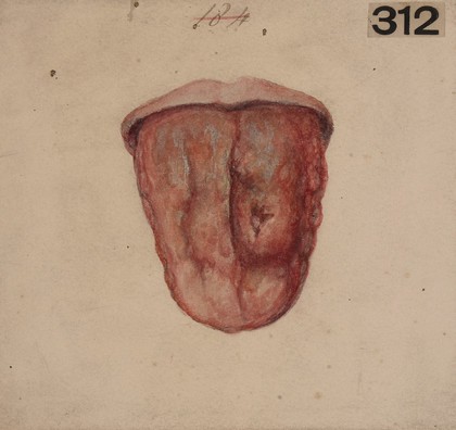 Tertiary syphilitic disease of the tongue