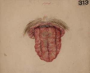 view Tertiary syphilitic disease of the tongue