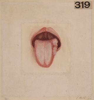 Lymphangioma of the left side of the tongue