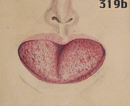 Lymphangioma of the tongue