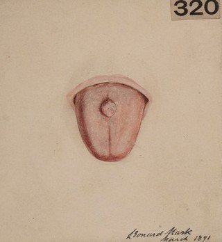 Small lymphangioma of the tongue