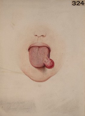 Congenital pedunculated tumour of the tongue