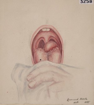 view Adenoma of the tongue