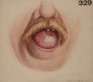 view Tongue showing an ichthyotic condition