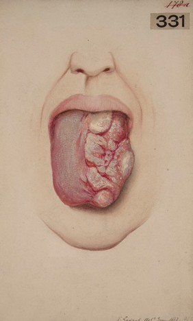 Warty, papillated growth on tongue