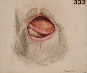 view Extensive epithelioma of the dorsum of the tongue