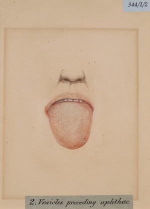view Vesicles on the tongue preceding aphthae
