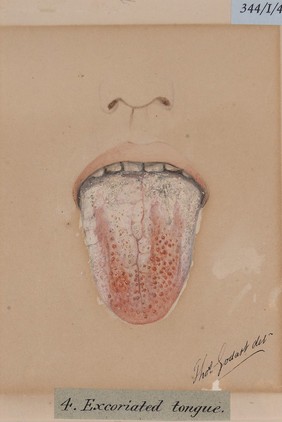 Excoriated tongue