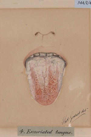 view Excoriated tongue