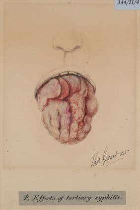 Effects of tertiary syphilis of the tongue