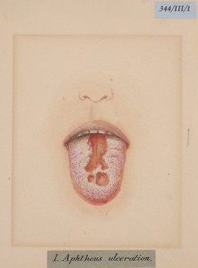 Aphthous ulceration of the tongue