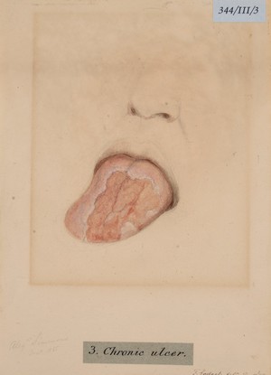 view Tongue with chronic ulcer