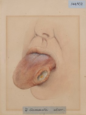 Gummatous ulcer of the tongue