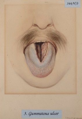 Gummatous ulcer of the tongue