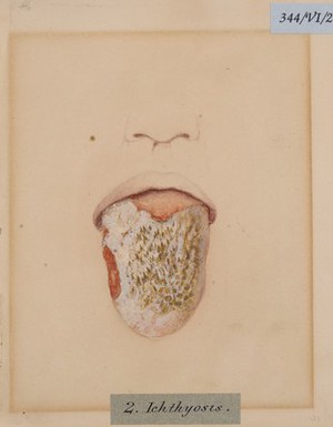 view Ichthyosis of the tongue