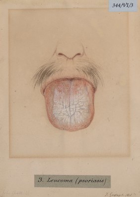 Leucoma of the tongue