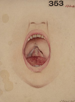 view Strumous ulceration of the soft palate