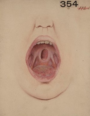 view Syphilitic ulceration of the soft palate