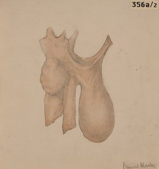 Pharyngeal pouch