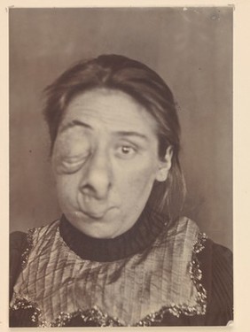 Face of a woman affected with lymphangiectasis