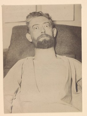 Man with a well-marked exophthalmic goitre