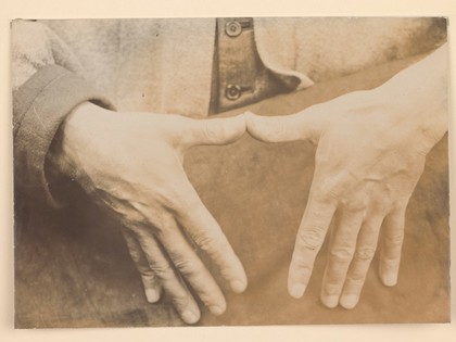 Hands of man with oedema