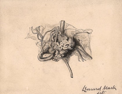 Angioma of the cerebral membranes