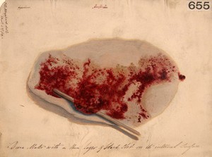 view Dura mater, with a thin layer of blood clot on its internal surface