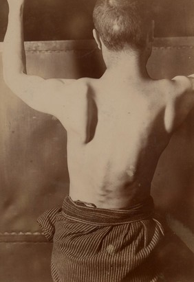 Paralysis of the left serratus magnus