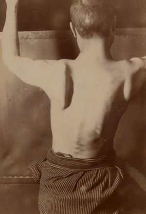 view Paralysis of the left serratus magnus