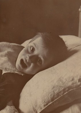 Child possibly suffering from diphtheritic paralysis of the lips and tongue