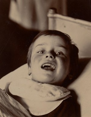 view Child possibly suffering from diphtheritic paralysis of the lips and tongue