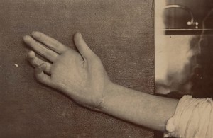 view Right hand and forearm of a boy suffering from paralysis of the ulnar nerve