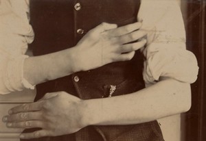 view Forearms and hands of a boy suffering from paralysis of the right ulnar nerve