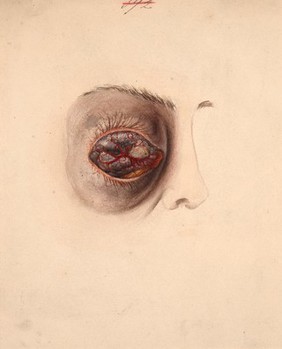 Melanotic sarcoma of the eye