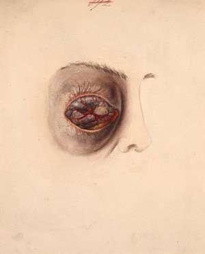 view Melanotic sarcoma of the eye