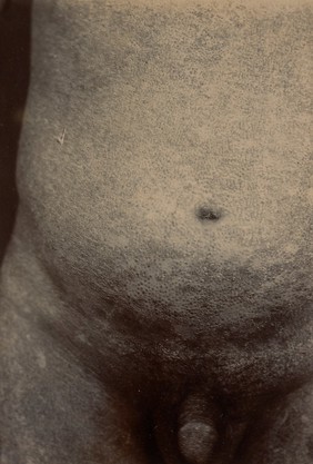 Abdomen from a case of pityriasis rubra pilaris