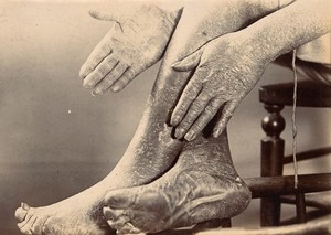 view Hands and feet from a case of pityriasis rubra pilaris