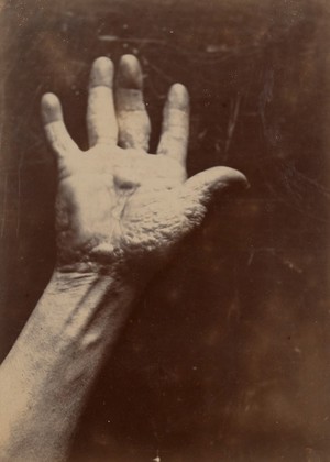 view Palm of the right hand of a man suffering from chiro-pompholyx